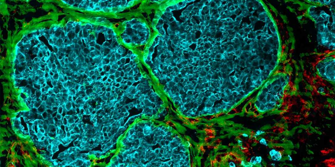 Enlarged view: How tumors transform blood cells